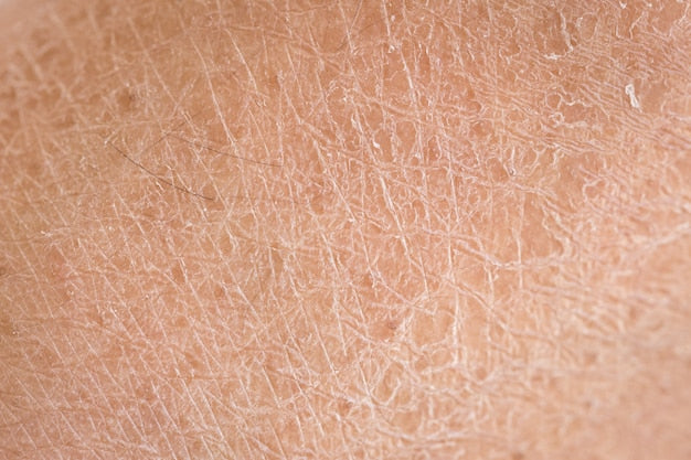 Why is my skin so dry?